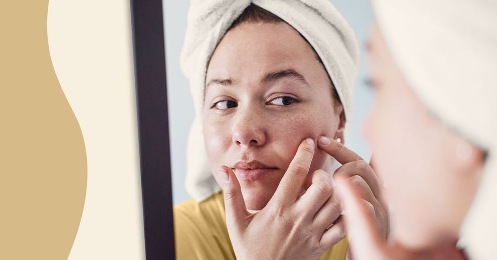 Acne Can Cost 362.5K To Treat. Here's Why Mira Health