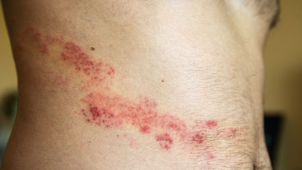 What are the early symptoms of shingles mira health